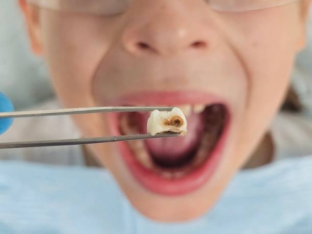 Best Dental Abscess Treatment in Tazewell, VA